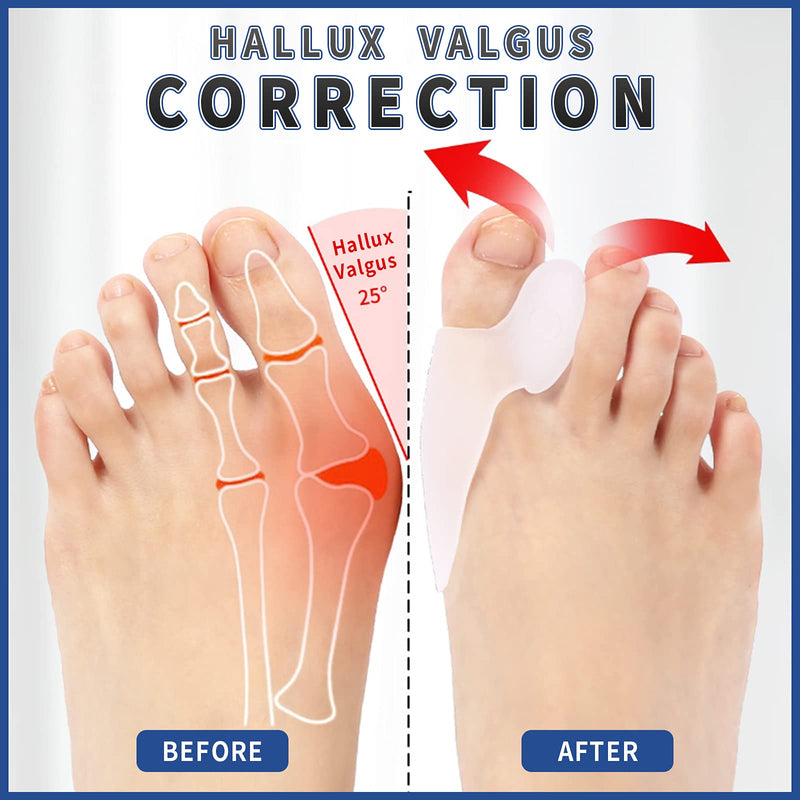 [Australia] - Bunion Guards, Bunion Protector Gel Shield For Pain Relief from Crooked Toes, Relieve Pain from Friction and Pressure Hallux, Bunions, Toe Spreader Cushion Bunion Pads (White) White 