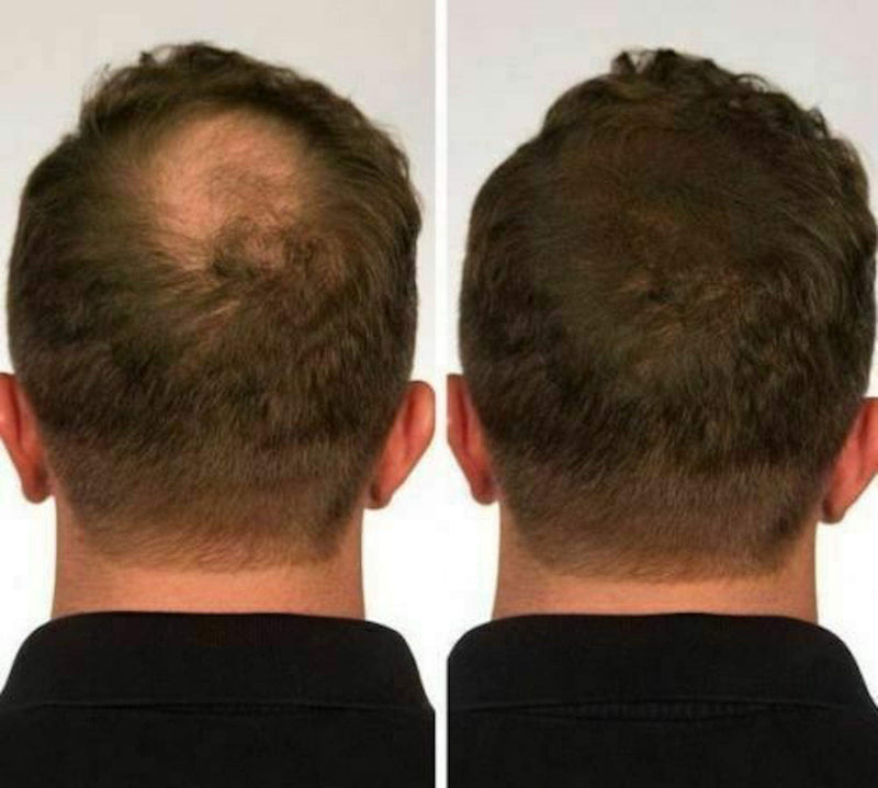 [Australia] - 100% Natural Keratin Hair Fibre Refill For Hair Loss - Alopecia & Chemotherapy (100g, Black) 100 g (Pack of 1) 