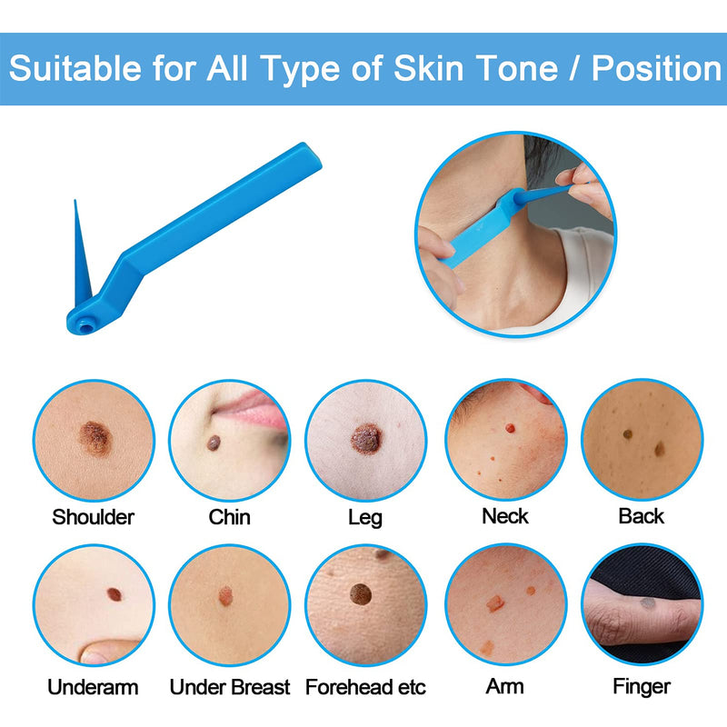 [Australia] - Rpanle Skin Tag Remover, Skin Tag Removal Kit with 20 Skin Tag Bands, Painless and Safe Remove Small to Large Sized (2mm to 4mm) Skin Tag 