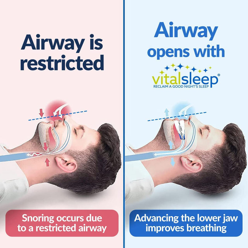 [Australia] - VitalSleep Anti-Snoring Mouthpiece, Adjustable Jaw Positioning, Custom Teeth Impressions, USA Made & FDA Cleared Snore Solution Mouth Guard 