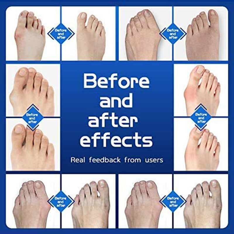 [Australia] - Pack of 10 Toe Separator Gel Bunion Corrector Relieve Hammer Toe，Bunion Corrector, Toe Separators with 2 Loops, Big Toe Spacer Suitable for Bunion and Overlap Toe (White) 