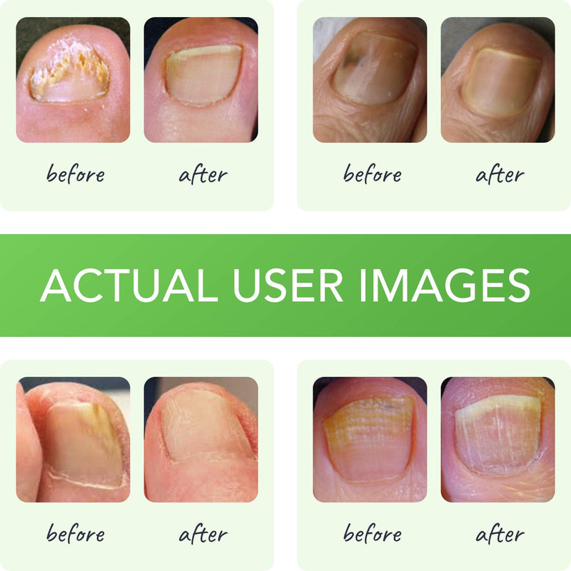 [Australia] - FUNGINIX Healthy Nail Formula - Finger and Toe Fungus Treatment, Made in USA, Eliminate Fungal Infections, Maximum Strength Solution (1 Fluid Ounce) 1 Fl Oz (Pack of 1) 