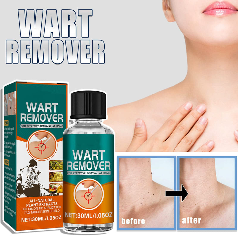 [Australia] - Skin-Tag-Removal,Fast-Acting Skin Wart Removal,Skin Tag Remover Liquid,Safe and Fast-Acting Skin Tag Remover,Natural Wart Remover for All Skin Types,30ml 