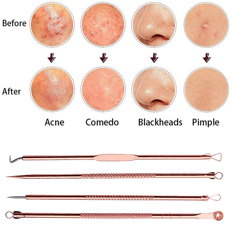 [Australia] - Blackhead Remover Tool Kit,4 Pieces Comedone Extractor Tool Blemish Whitehead Removal Acne Needle Pimple Spot Popper Stainless Steel (Gold) Gold 