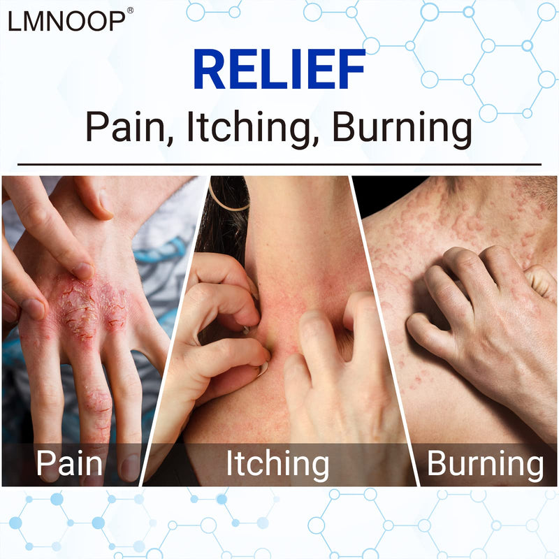 [Australia] - LMNOOP Eczema Cream, Maximum Strength Treatment Ointment for Rash, Psoriasis, Dermatitis, Urticaria, Tinea Pedis, Fungal Infection, Anti-Itch, Relief for Sensitive, Irritated Skin 