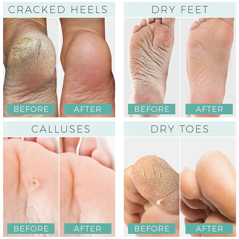 [Australia] - Foot Peel Mask - 2 Pack - For Cracked Heels, Dead Skin and Calluses - Make Your Feet Baby Soft Smooth Silky Skin - Removes Rough Heels, Dry Toe Skin Natural Treatment. (Lemongrass Scent) 