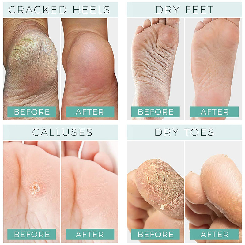 [Australia] - Foot Peel Mask - For Cracked Heels, Dead Skin & Calluses - Makes Your Feet Baby Soft - Removes & Repairs Rough Heels, Dry Toe Skin - Exfoliating Peeling Natural Treatment (2 Pack, Women's 5-11) Women's 5-11 (2 Pack) 