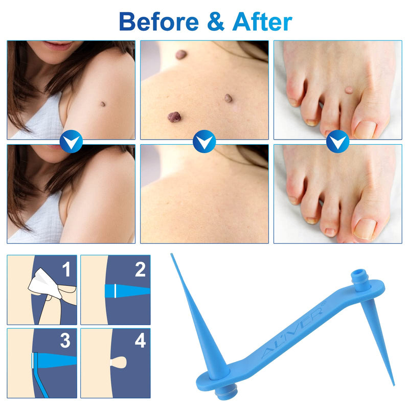 [Australia] - 2 in 1 Skin Tag Remover Kit,Easy to Use for 2-7mm Skin Tag Face Care Mole Wart Tool Skin Tag Removal Patches,Fast Effective & Safe Painless 