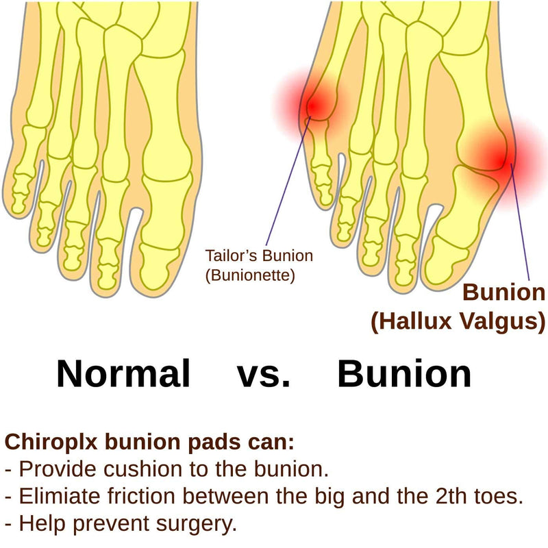 [Australia] - Chiroplax Bunion Corrector Relief Cushion Pads Guard Toe Separator Straightener Splint Protector Shield Spacer Sleeve Cover Hallux Valgus (4 Pads w/Shims, Size Regular) Size Regular (Pack of 4) 