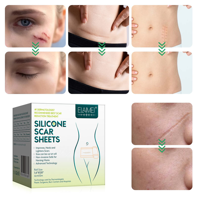 [Australia] - Silicone Scar Sheets, Professional for Scars Caused by C-Section, Surgery, Burn, Keloid, Acne, and More, Drug-Free, Silicone Scar Roll [3Meters] 