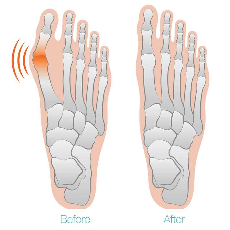 [Australia] - Bunion Corrector and Orthopedic Pain Relief Gel Pad Toe Separator Cushions Hammer Toe, Overlapping Toe, Improves Toe Realignment for Men and Women with Heel Band (Small) Small 