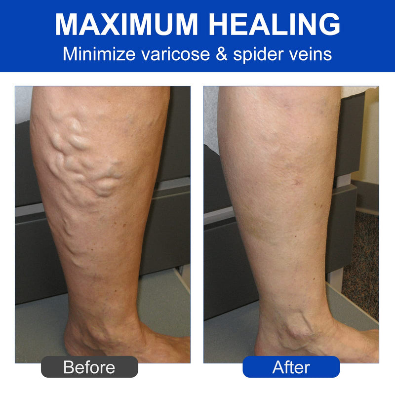 [Australia] - Varicose Veins Treatment for Legs, Varicose Veins Patch, Relief Leg Pain & Spider Varicose Vein, Strengthen Capillary Health & Improve Blood Circulation，36pcs 36pcs 