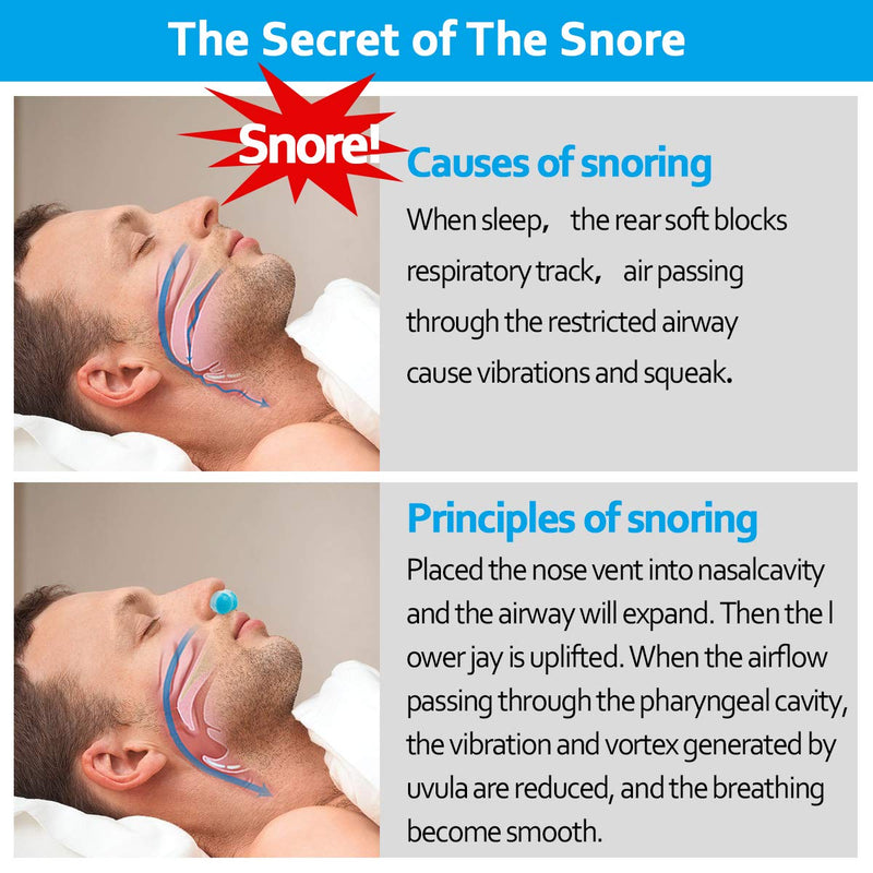 [Australia] - Anti Snoring Devices - Effective Snore Stopper for CPAP Users, Anti Snore Nasal Dilators Nose Vents Plugs for Stop Snoring,Snoring Solution Relieve Snore Better Sleep Devices That Work for Women Men 2PCS Anti Snoring Devices 