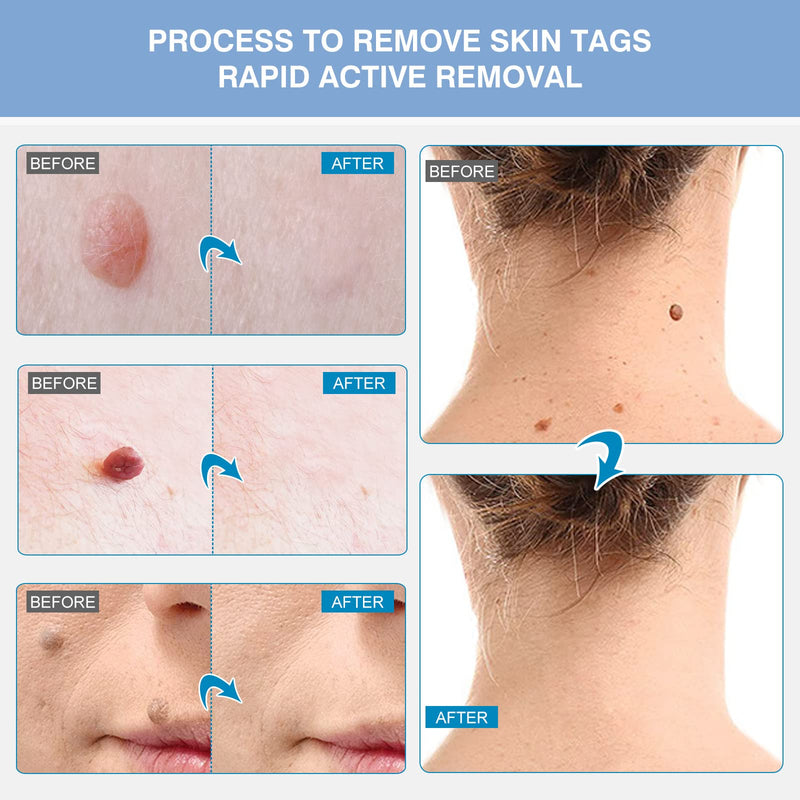 [Australia] - Memonotry Skin Tag Remover, Skin Tag Removal Kit Tools with 40Pcs Repair Patches for Micro to Small Skin Tags, Easy Application Device to Remove Skin Tags 5 