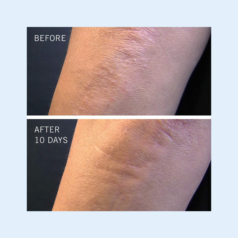 [Australia] - First Aid Beauty KP Bump Eraser Body Scrub Exfoliant for Keratosis Pilaris with 10% AHA 