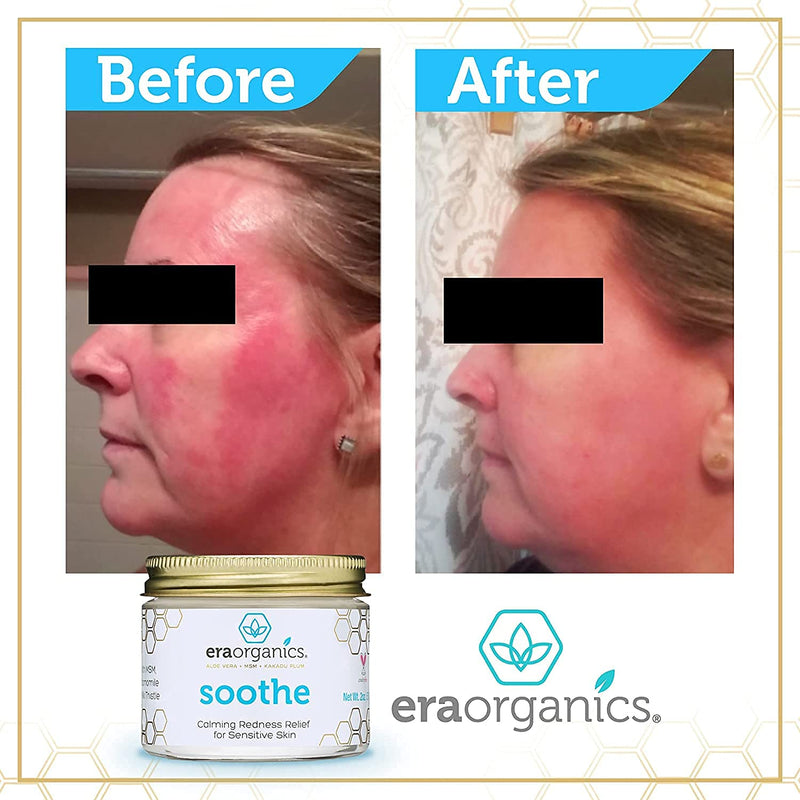 [Australia] - Era Organics Rosacea Redness Relief Cream - Soothe Dry Skin Irritation Calming Face Moisturizer For Rosacea, Eczema, Acne Prone Skin- Sensitive Skin Care With Milk Thistle, MSM, Avocado Oil, Chamomile 