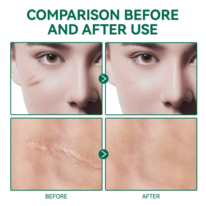 [Australia] - Advanced Silicone Scar Gel,Scar Removal Gel Cream for Old or New Scars- C-Section, Keloid, Tummy Tuck, Surgery-Natural Treatment with Vitamin E,Retinol-50ML 