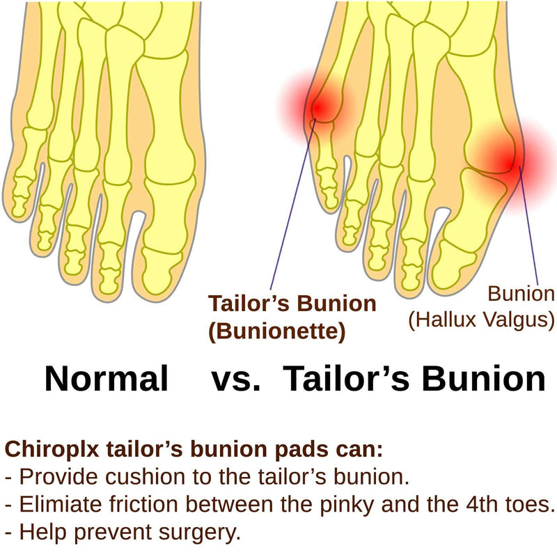 [Australia] - Chiroplax Tailor's Bunion Corrector Pad Bunionette Straightener Separator Cushion Pinky Toe Protector Shield Pain Relief Spacer Splint Cover Guard (6 Pack) 
