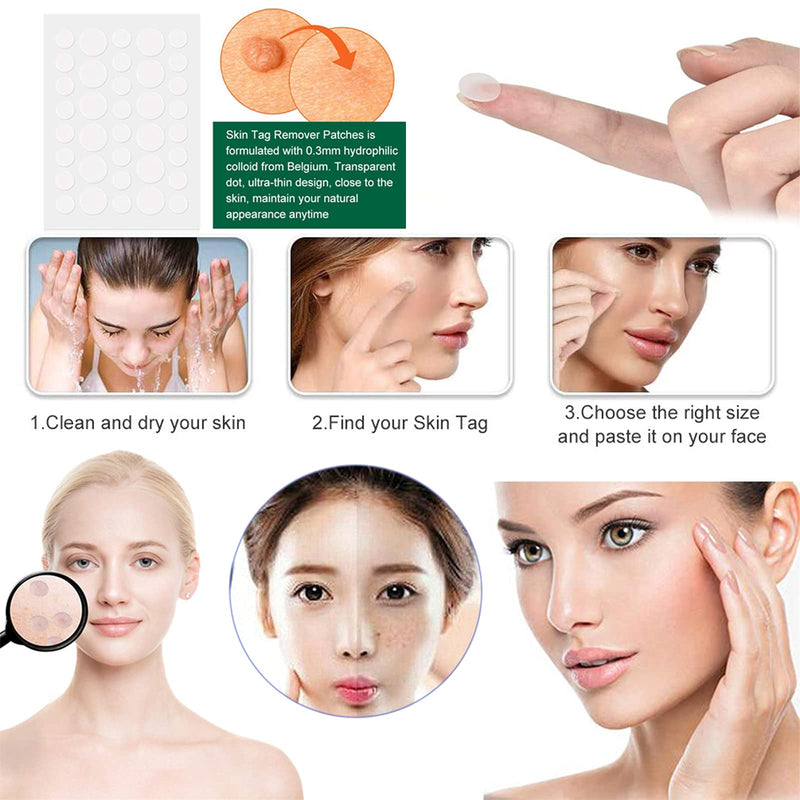 [Australia] - Rpanle Skin Tag Remover, Skin Tag Removal Kit with 20 Skin Tag Bands, Painless and Safe Remove Small to Large Sized (2mm to 4mm) Skin Tag 