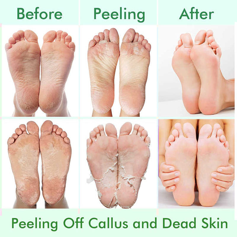 [Australia] - 5 Pack Foot Peel Mask,Exfoliator Peel Off Calluses Dead Skin Callus Remover,Foot Mask for Dry Cracked Feet,Foot Peel Mask with Lavender and Aloe Vera Gel for Men and Women Feet Peeling Mask 