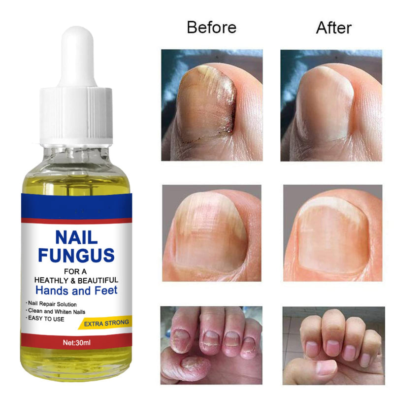 [Australia] - Nail Fungal Treatment, Toenail Treatment Extra Strong Nail Repair Set, Fingernail Toenail Care, Fix Renew Damaged, Broken, Anti Fungus Nail Repair 