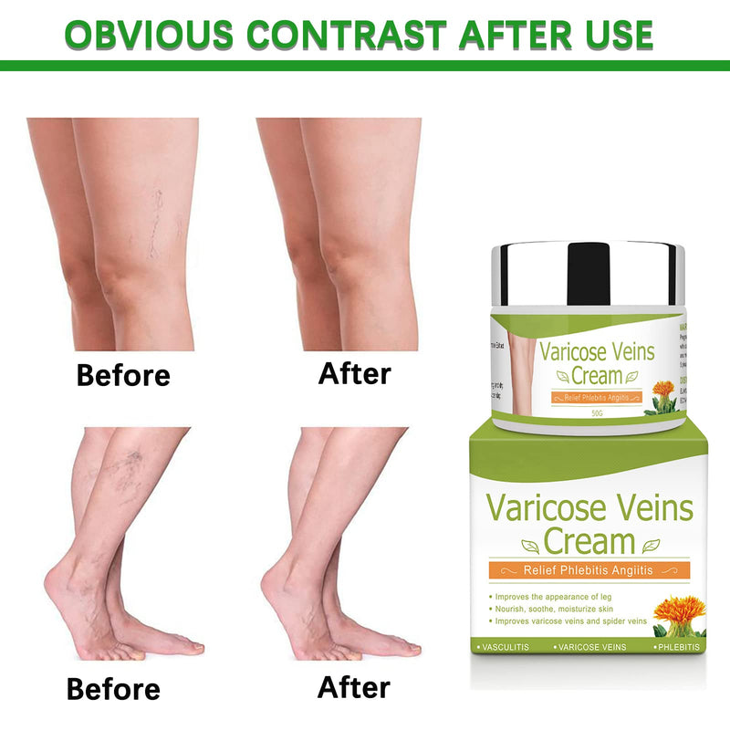 [Australia] - Varicose Veins Cream for Legs Veins Herbal Ointment Relief Phlebitis, Varicose Veins Treatment Cream for Legs Improve Foot Spider Veins,Suitable for Men&Woman picture 