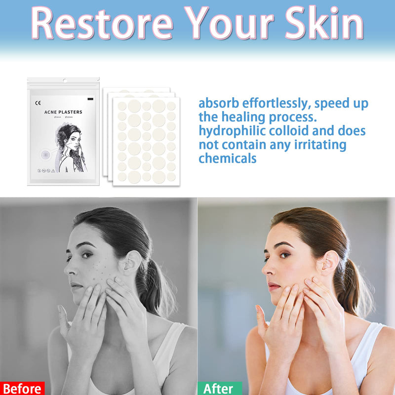 [Australia] - Pimple Patches, 216 Spot Patches, Hydrocolloid Patches, Invisible Acne Stickers for Skin Treatment (8mm,12mm) 