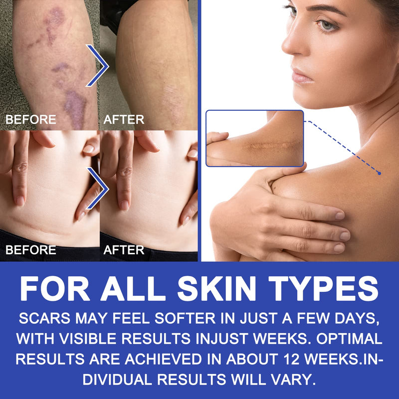 [Australia] - Advanced Silicone Scar Sheets, Transparent Strips, Gel Tape for Scar Removal, Reusable and Effective Removal New and Old Scars(4X300CM Roll) Blue 