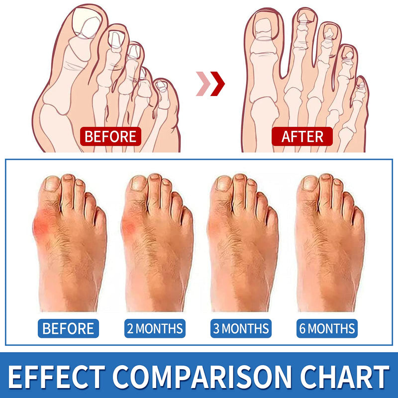[Australia] - JANMISI Bunion Corrector, Orthopedic Bunion Splint for Men and Women, Big Toe Hallux Valgus Hammer Toe Straightener (Night use) Night use 
