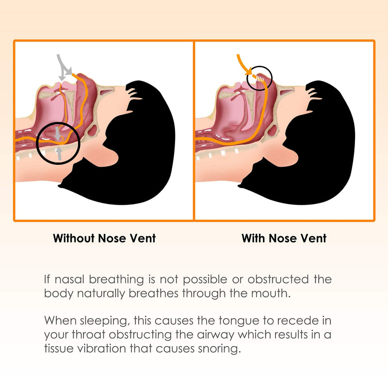 [Australia] - Nose Vent Sinus Relief Dilator (Pack of 12 Large Size) Hard Silicone Vents - A Simple Solution for Nasal Snorers - Reusable Snoring Device to Enjoy a Peaceful Night's Sleep by Mobi Lock Pack of 12 - Large - Hard Silicone 