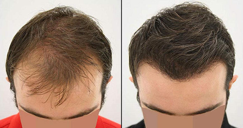 [Australia] - 100% Natural Keratin Hair Fibre Refill For Hair Loss - Alopecia & Chemotherapy (100g, Black) 100 g (Pack of 1) 