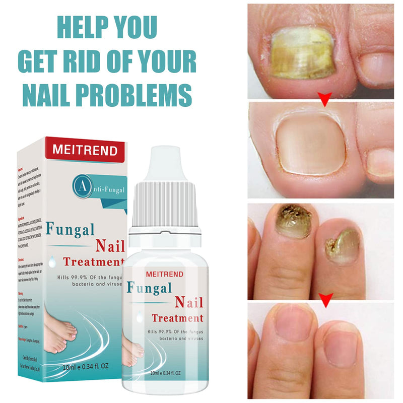 [Australia] - Fungal Nail Treatment For Toenails ,Nail Strengthener, Strong Toe Nail Fungal Treatment, Nail Fungus Treatment 