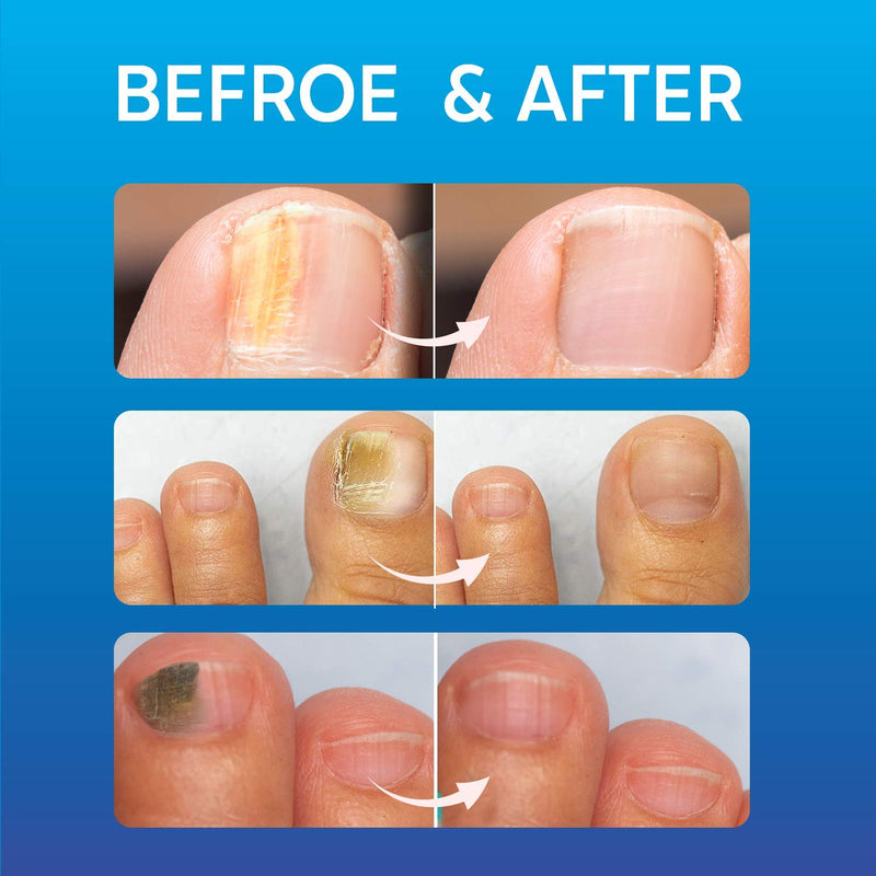 [Australia] - Fungal Nail Treatment, Fungus Nail Cream, Strong Anti-Fungal Toenail Cream, Nail Repair Nourishing Treatment, Restores Discolored and Damaged Nails 