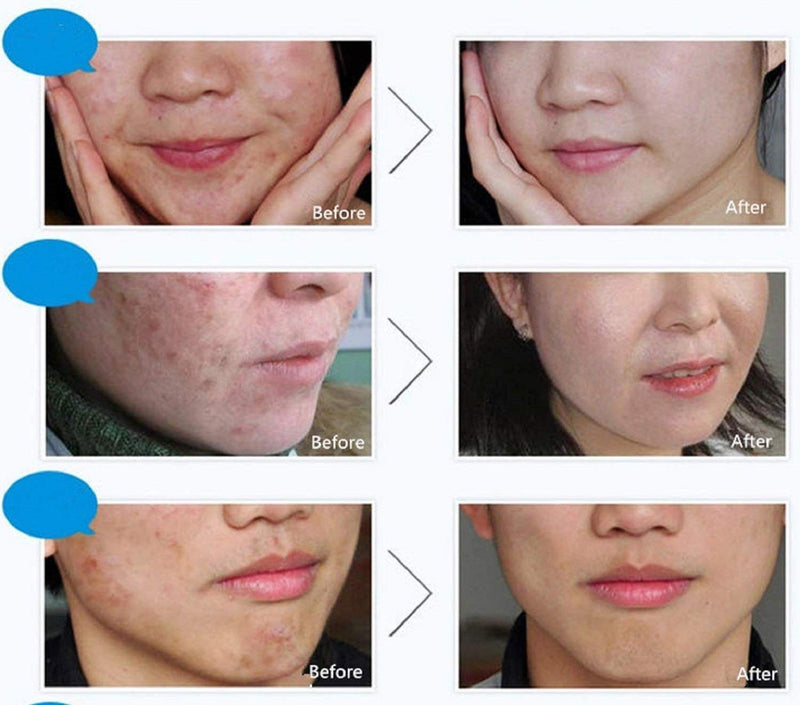 [Australia] - BIOAQUA 4in1 Face Acne Treatment Scar Removal Spots Whitening Oil Cream Face Masks Scar Blemish Marks Moisturizing Oil 100g+30g+30ml+4pcs X30g 