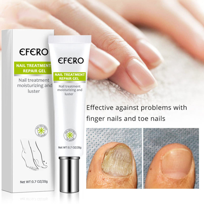 [Australia] - Fungal Nail Treatment, Fungus Nail Cream, Fungal Nail Eliminator for Toenails and Fingernails Strong Anti-Fungal Toenail Cream, Nail Repair Nourishing Treatment 