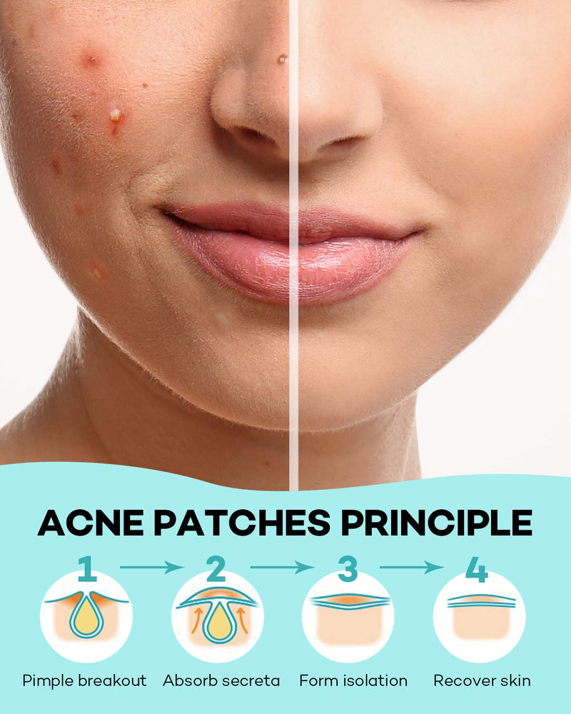 [Australia] - Acne Patch Pimple Patch, 4 Sizes 140 Patches Acne Absorbing Cover Patch, Hydrocolloid Invisible Acne Patches For Face Zit Patch Acne Dots Tea Tree, Calendula Oil - 1 Pack 140 Patches (1 Pack) 