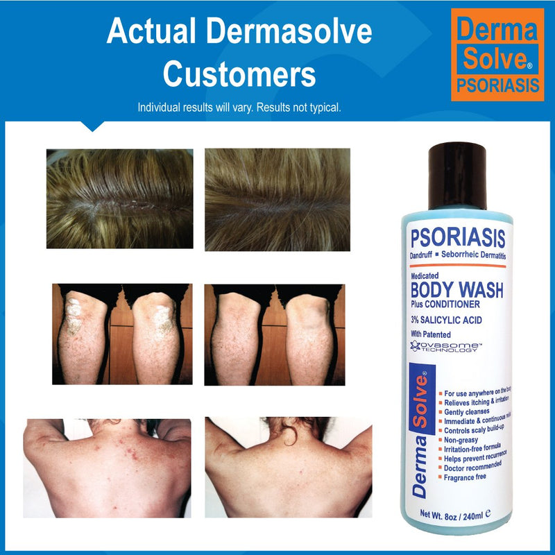 [Australia] - Psoriasis Body Wash by DermaSolve (2-Pack) | Psoriasis, Eczema, Seborrheic Dermatitis - Proven to Provide Relief from Dry Itchy Red Flaky Scaly and Inflamed Skin - Doctor Recommended (8.0 oz each) 