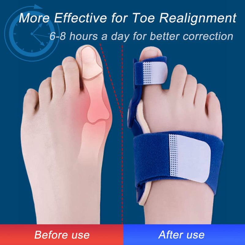 [Australia] - Paskyee Bunion Corrector, Orthopedic Bunion Toe Straightener for Women and Men 2 PCS, Adjustable Bunion Splint with Toe Separator for Bunion Relief Blue 