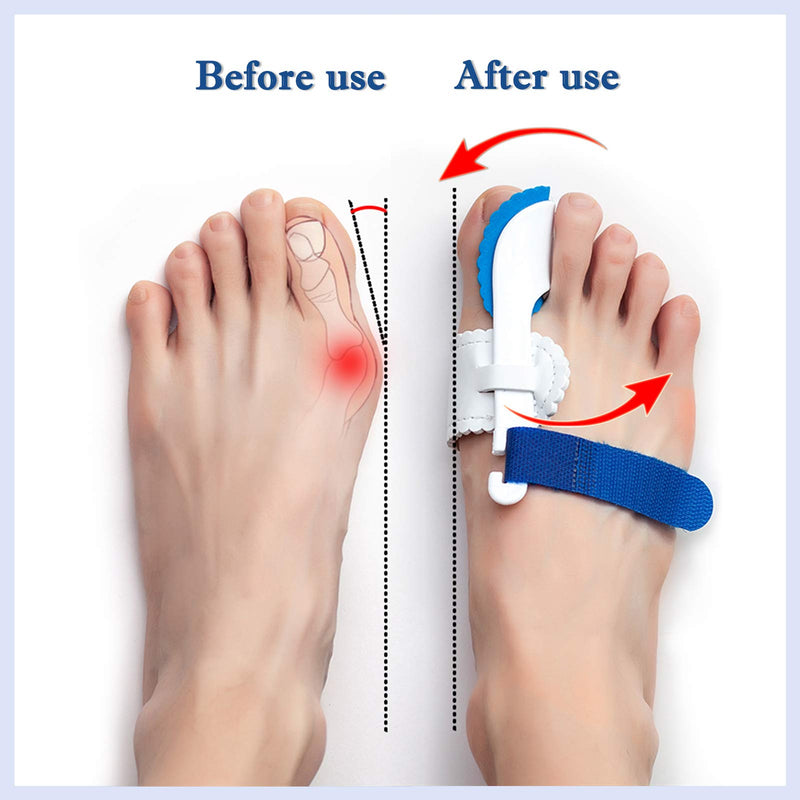 [Australia] - Bunion Valgus And Bunion Valgus Corrector, Hallux Valgus Corrector,Big Toe Joint, Adjustable Bunion Valgus Protective Cover For Men And Women (For Men And Women) 