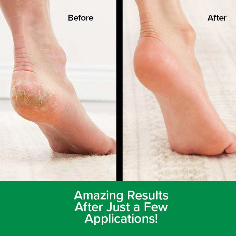 [Australia] - Original Hempvana Heel Tastic Intensive Heel Repair Therapy for Dry, Cracked Heels - Enriched with Cannabis Seed Extract In The Form of Oil - Cracked Heel Treatment for Women + Men 