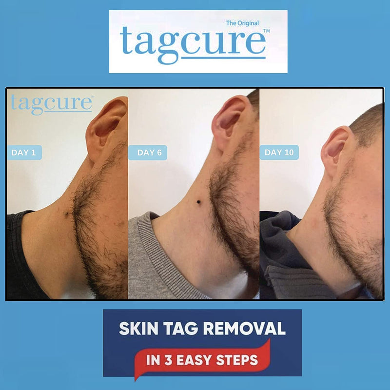 [Australia] - Tagcure Skin Tag Removal Kit For Easy Skin Tag Removal - Includes x10 Tag Bands x10 Cleaning Swabs & x10 Plasters & 15ml Oil (Suitable for Skintags 0.5cm or Less) 