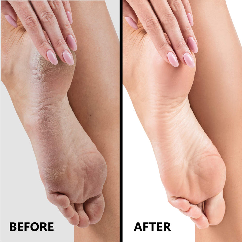 [Australia] - SlkySmooth 3-in-1 Foot File | Hard Dead Skin Remover | Cracked Heels Callus Pedicure Scrubber Corn Removal | Scraper Grater Pumice Stone Exfoliator Rasp Pedi Exfoliating Heel Files for Feet Care 