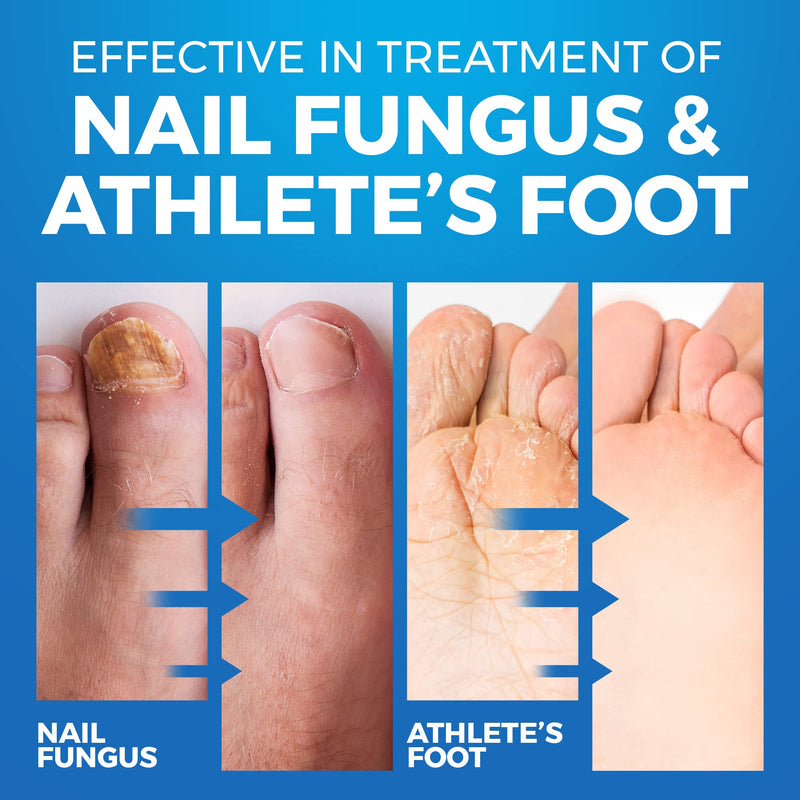 [Australia] - Shoe and Sock Spray for Fungal Nail Treatment | Athletes Foot & Anti Toe Nail Fungus Treatment | Ringworm Foot Care Shoe Freshener | 150 ML Imperial Feet 