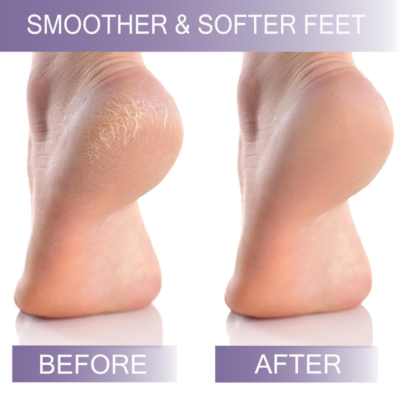 [Australia] - Pumice Stone for Feet Hard Dry Cracked Heel Feet Callus Scrub Remover Foot Scrub Pedicure Ideal for Dry Skin On Feet - Pack of 3 Purple 1 count (Pack of 3) 