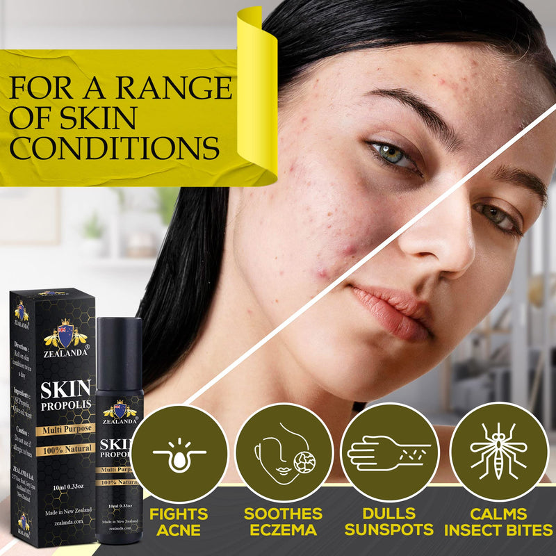 [Australia] - ZEALANDA Skin Propolis, Multi Purpose 100% Natural No Alcohol Treatment for Acne, Pimple, Eczema, Callus, Sunspot ,Skin Rash, Insect Bites, Cuts & Wounds. Made & Packed in New Zealand 