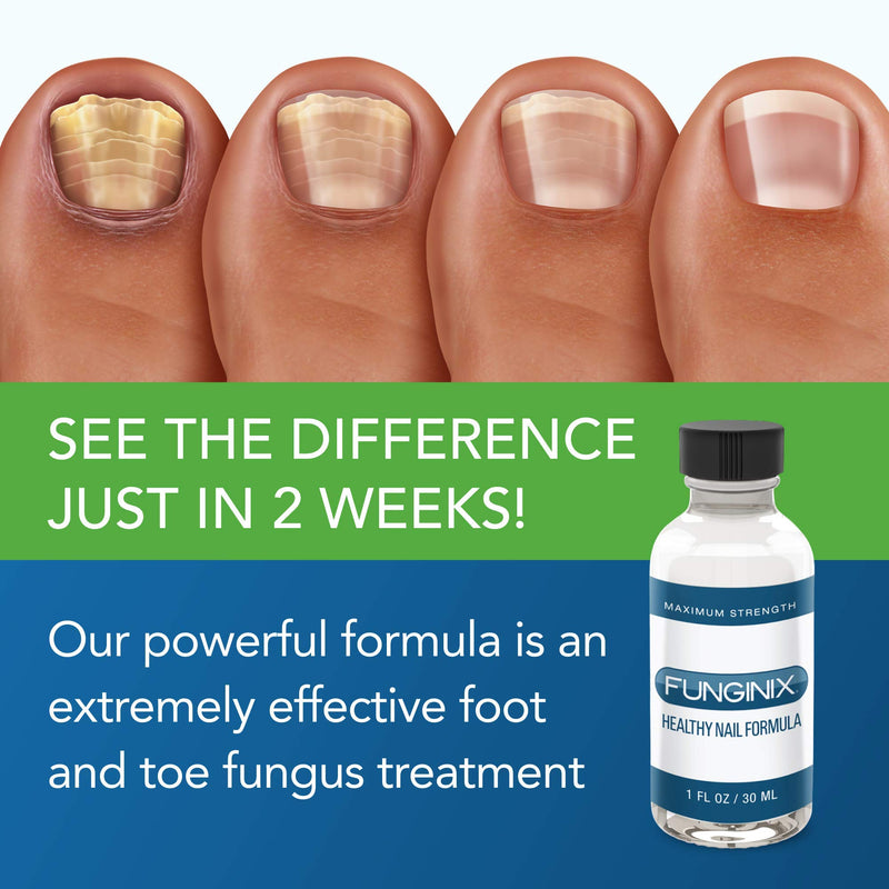[Australia] - FUNGINIX Healthy Nail Formula - Finger and Toe Fungus Treatment, Made in USA, Eliminate Fungal Infections, Maximum Strength Solution (1 Fluid Ounce) 1 Fl Oz (Pack of 1) 