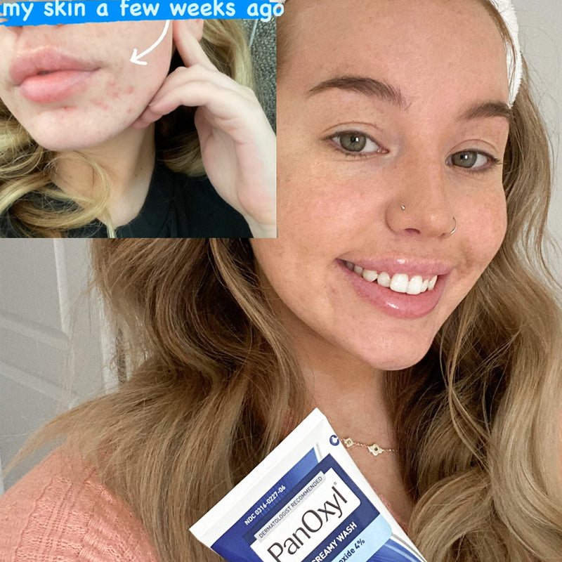 [Australia] - PanOxyl Antimicrobial Acne Creamy Wash, 4% Benzoyl Peroxide, 6 Ounce 4% Wash 