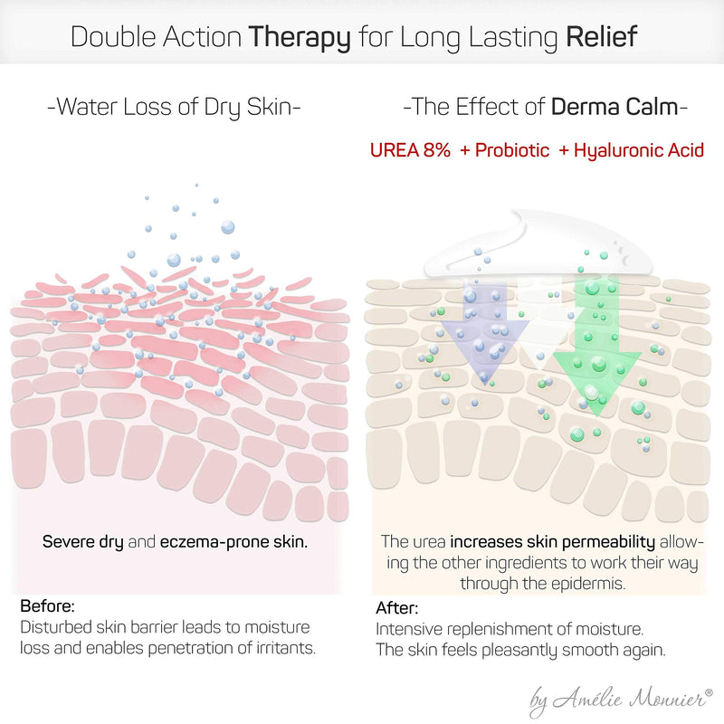 [Australia] - Clinically Tested Cream for Eczema, Dermatitis and Psoriasis Treatment - Urea 8%, Probiotics w/Best Natural Ingredients - Face & Body Lotion - Itchy, Severely Dry, Scaly Skin. Moisturizer 