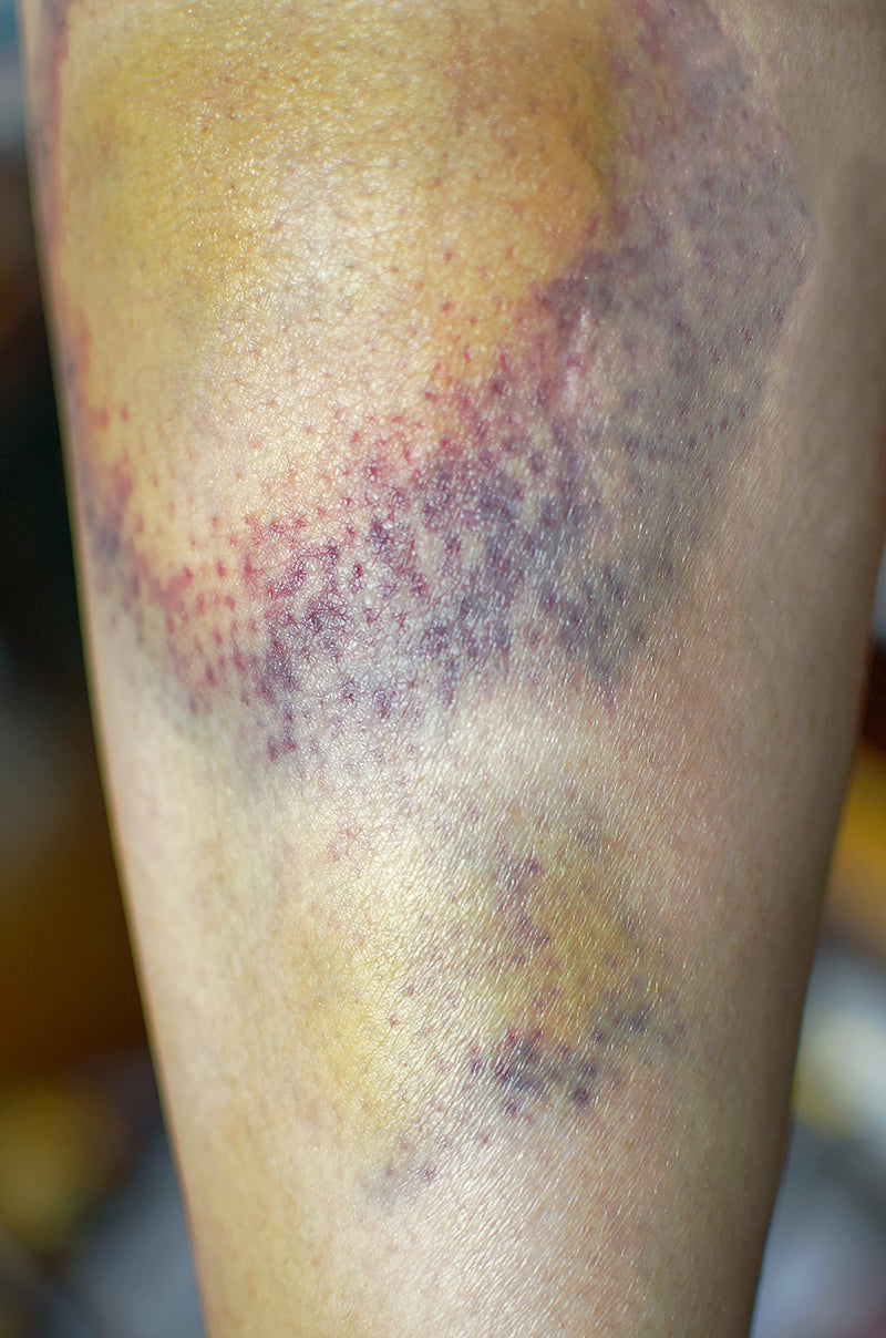 [Australia] - Arnica Bruise Cream Arnica Oil for Bruising Arnica Massage Oil Arnica Massage Balm Made in Yorkshire (250ml Oil) 250ml Oil 
