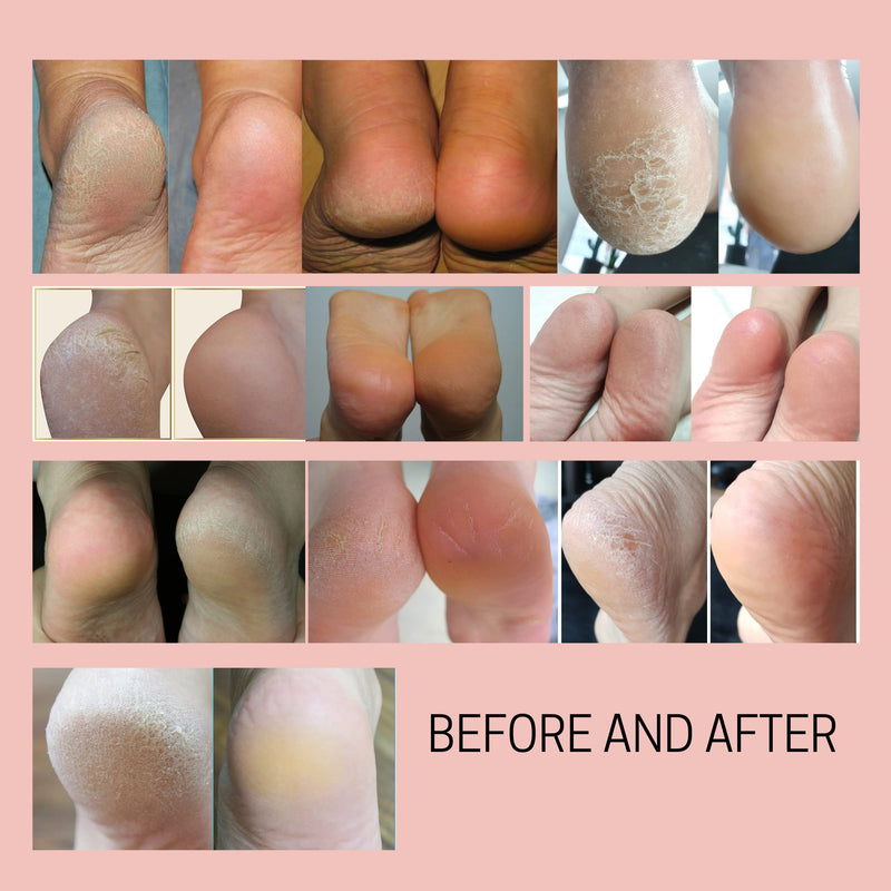 [Australia] - Callus Remover Instant Exfoliating Softener Peel Spray for Feet - Double Sided Foot File - Heels Callus Scrubber – Home Spa Pedicure Treatment. Wonder Pedi (Foot File + Softener) Foot File + Softener 